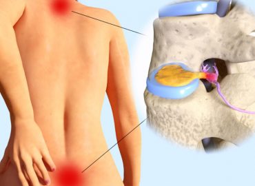 Spinal-disc-herniation-495474766_8000x6000-825x510