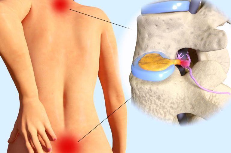 Spinal-disc-herniation-495474766_8000x6000-825x510