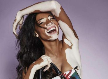 vitiligo-ese-gran-desconocido
